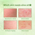 Remove Face Oil Acne Gentle Moisturizing Acne Pit Repair Liquid Fade Face Acne Marks Essential Oil - ROUTINE FASHION